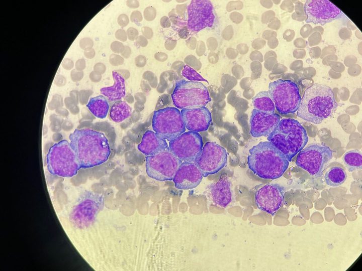 Blood smear: plasma cells with signs of polymorphism