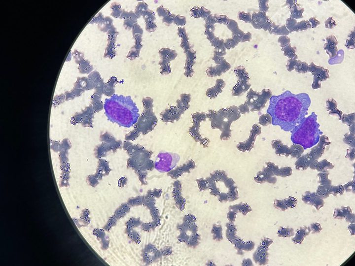 Blood smear: atypical plasma cells in the field of view