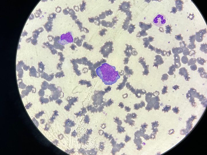 Blood smear: giant plasma cell and segmented neutrophil