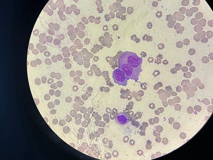 Blood smear: trinucleated giant plasma cell