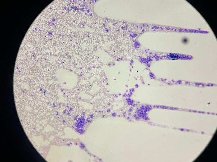 Blood smear: cluster of large cells in the feathered edge of the preparation