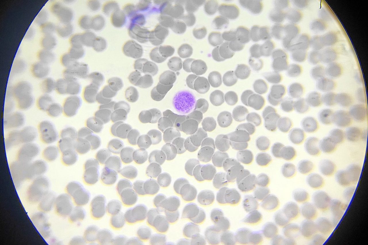 Giant Platelets: Morphology and Analyzer Errors