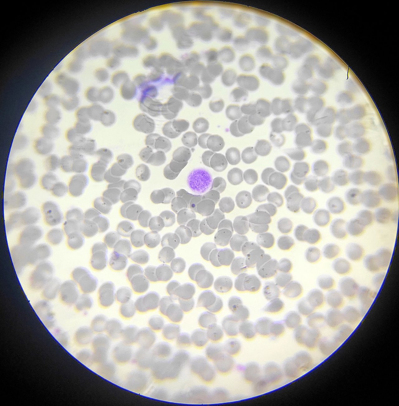 Blood smear: giant platelet, exceeding the size of surrounding red blood cells