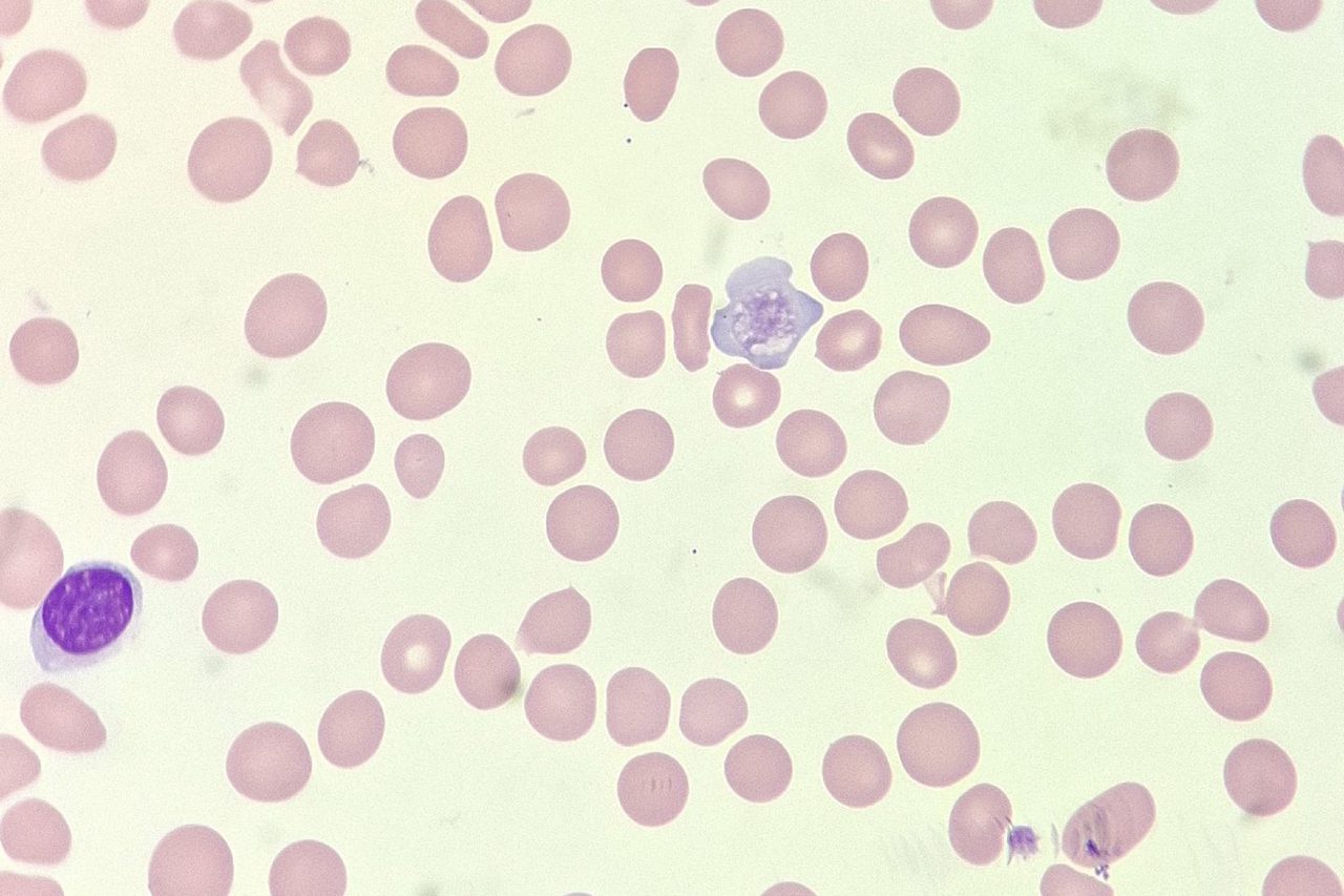 Giant Platelets in Secondary Myelofibrosis