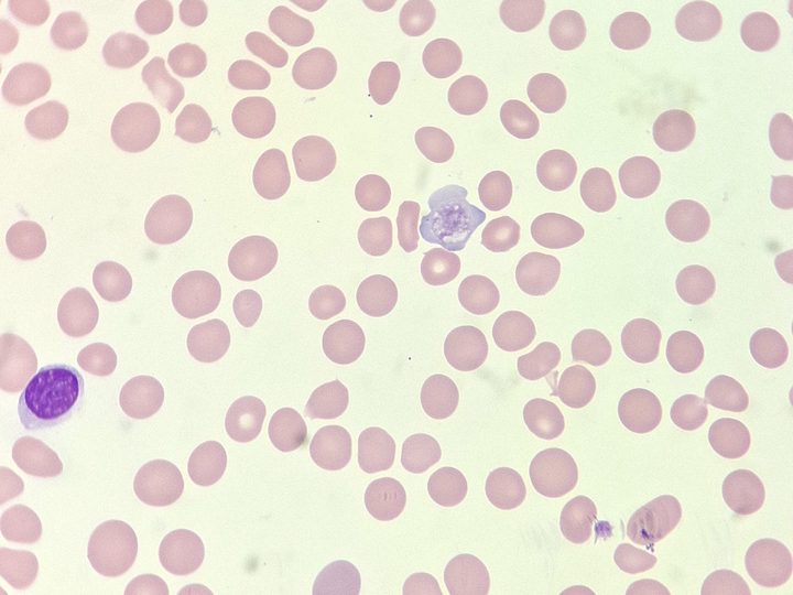 Blood smear: giant platelet in the center of the field of view and a mature lymphocyte on the left