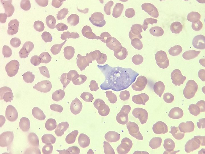 Blood smear: large atypical platelet, pronounced anisopoikilocytosis and dacryocytes