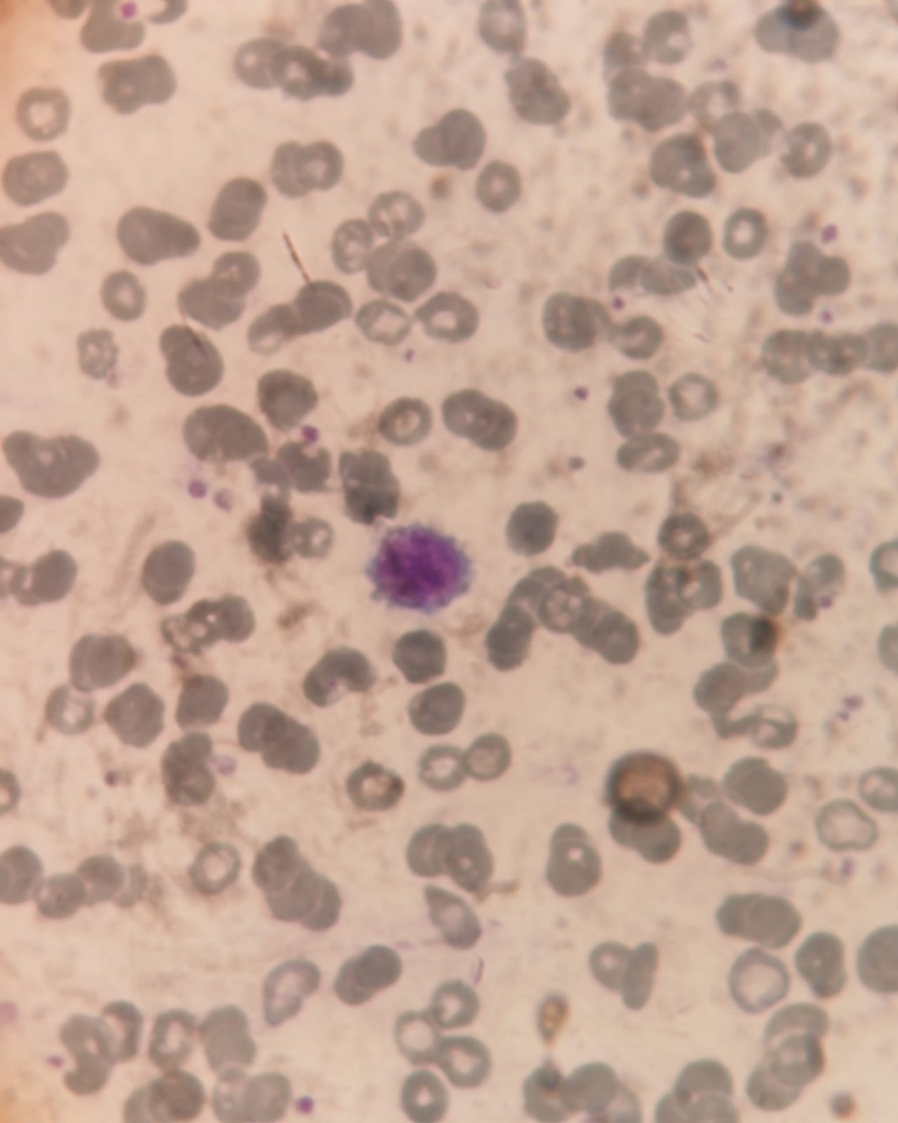 Giant Platelets in Blood Smear During Pregnancy