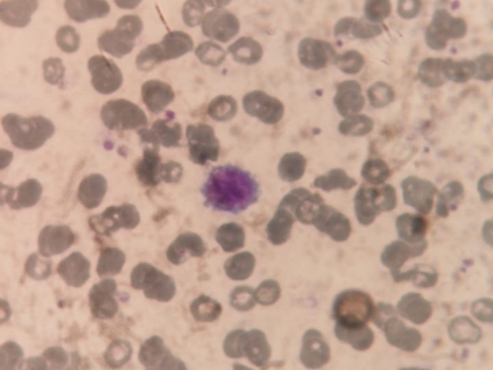 Blood smear: giant platelet with abundant granulation