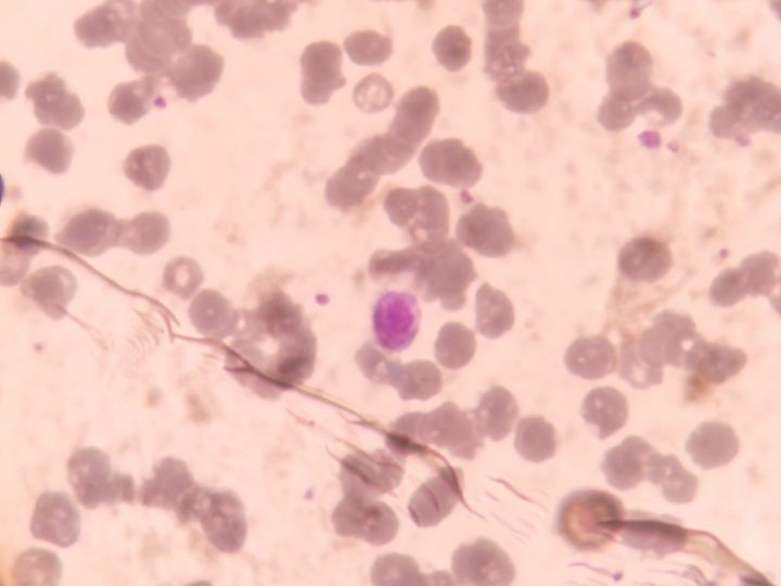 Blood smear: macroplatelets in a peripheral blood preparation