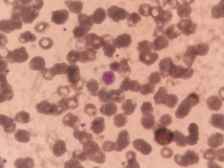 Blood smear: large young platelet in a smear from a pregnant woman