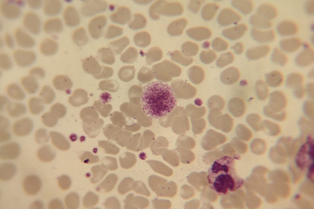 Giant Platelets in Blood Smear: Causes and Significance