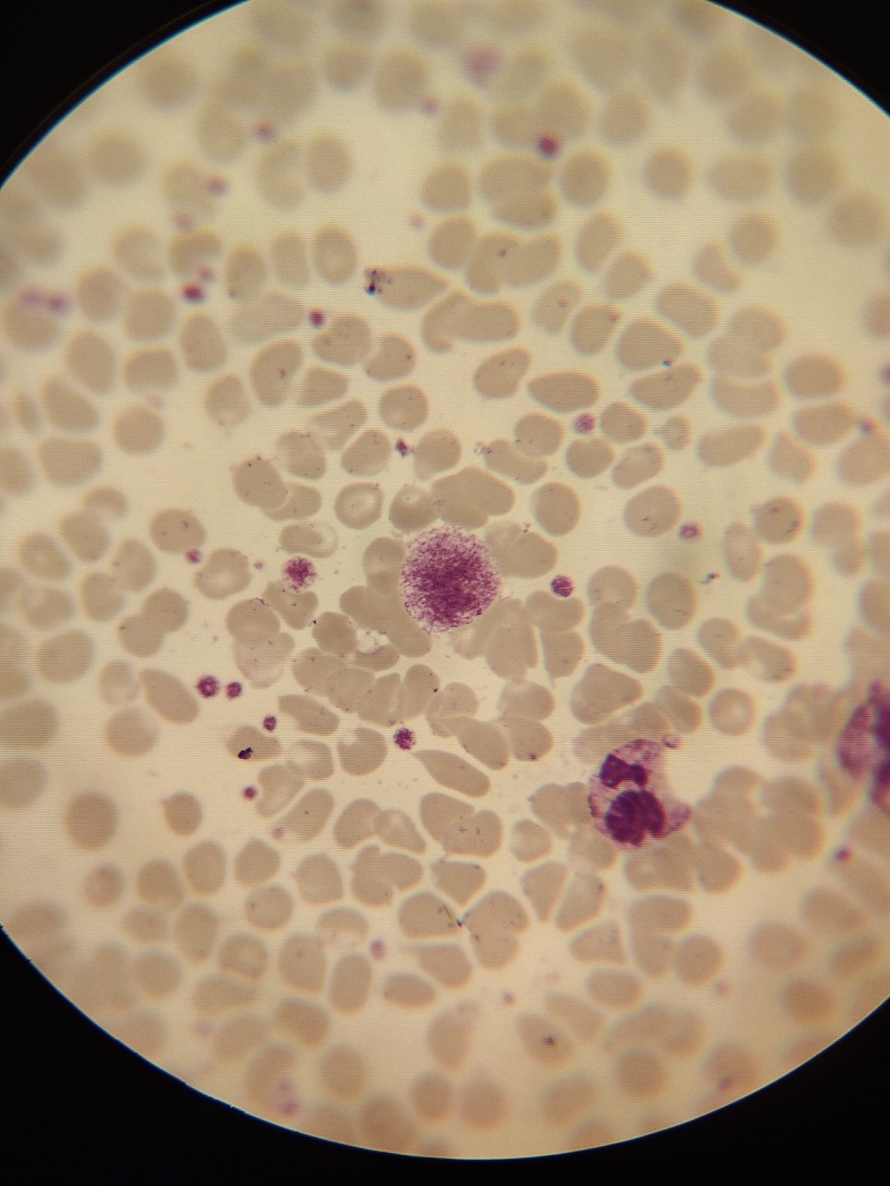 Blood smear: giant platelet (macrothrombocyte) in the center of the field of view