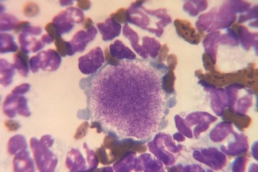 Giant Platelet in a Peripheral Blood Smear