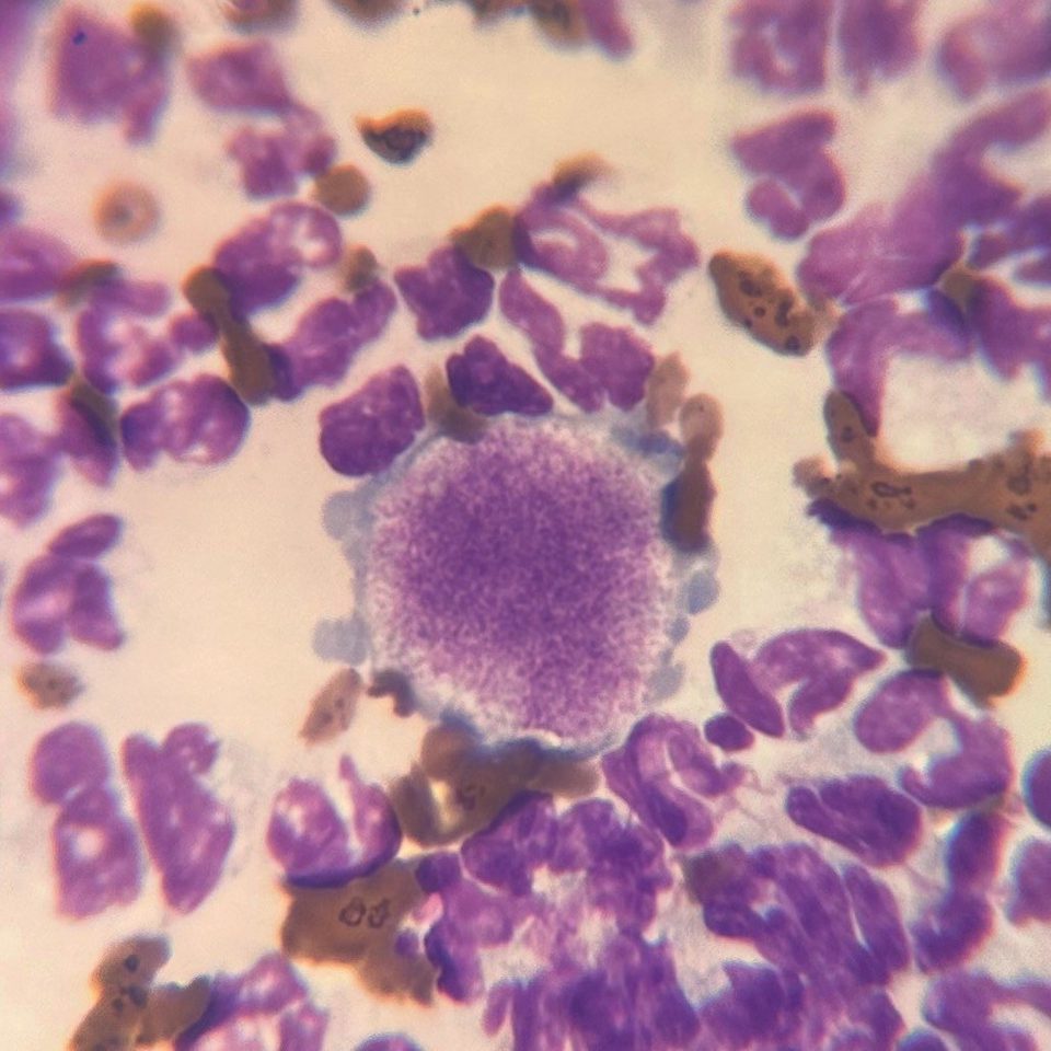 Blood smear: giant platelet in the center of the field of view, x1000 mag.