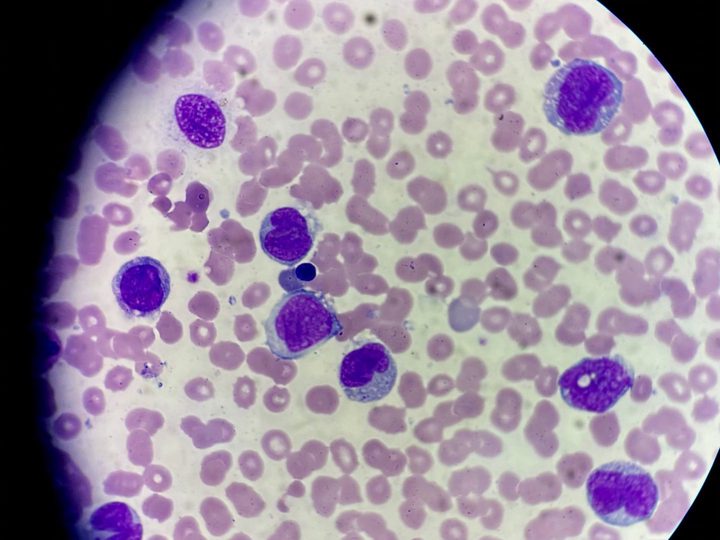 Мазок крови: поле зрения с высоким содержанием бластных эквивалентов