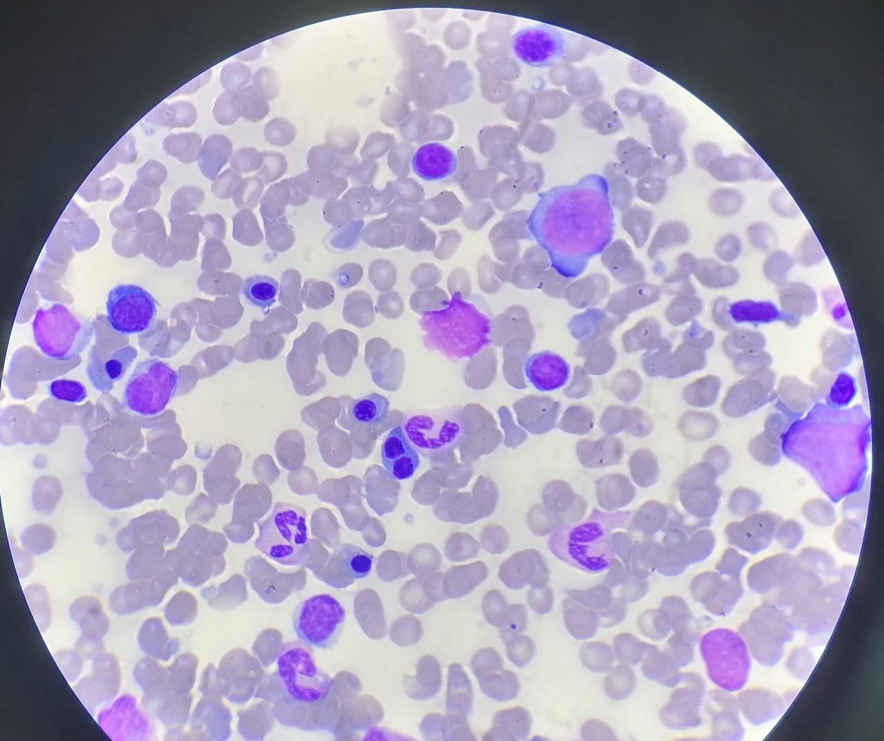 Bone Marrow Erythroid Hyperplasia in Splenomegaly Case