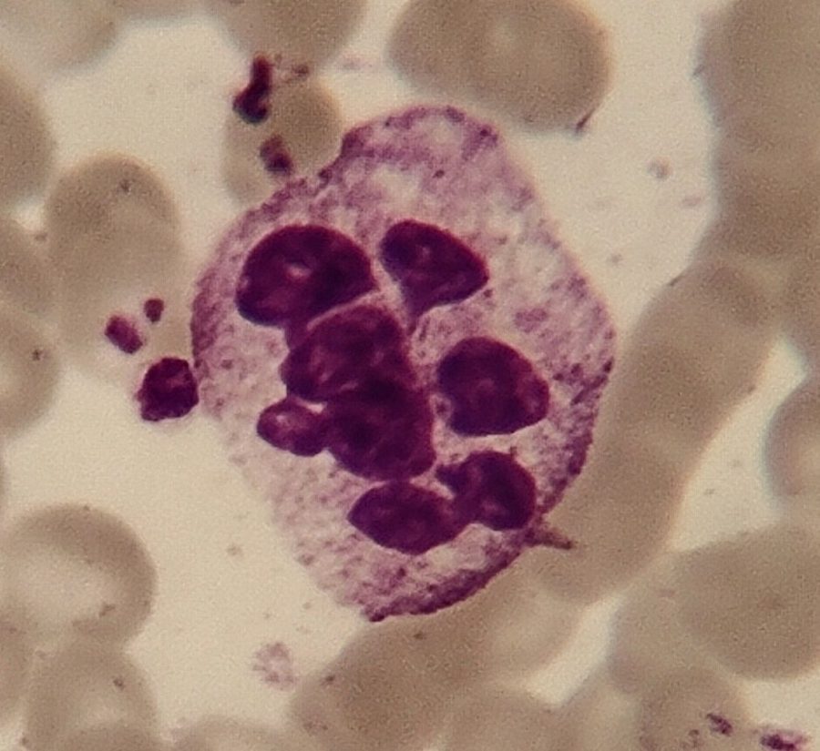 Neutrophil Hypersegmentation: Diagnostic Criteria