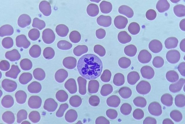 Neutrophil Hypersegmentation: Causes and a Clinical Case