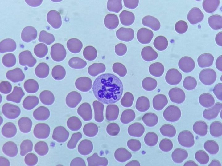 Blood smear: hypersegmented neutrophil with multiple nuclear segments