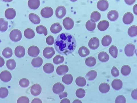 Blood smear: pronounced hypersegmentation of the neutrophil granulocyte nucleus