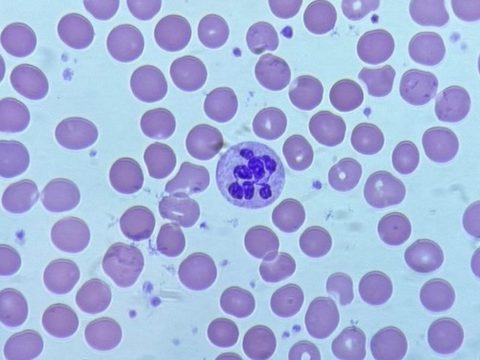 Blood smear: hypersegmented neutrophil containing more than 6 nuclear segments