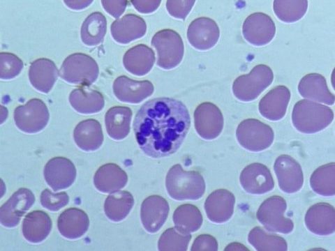 Blood smear: neutrophil hypersegmentation against a background of pronounced anisocytosis