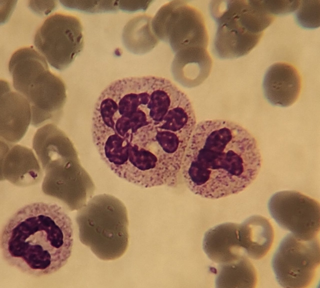 Neutrophil Hypersegmentation: Causes and Diagnostic Criteria