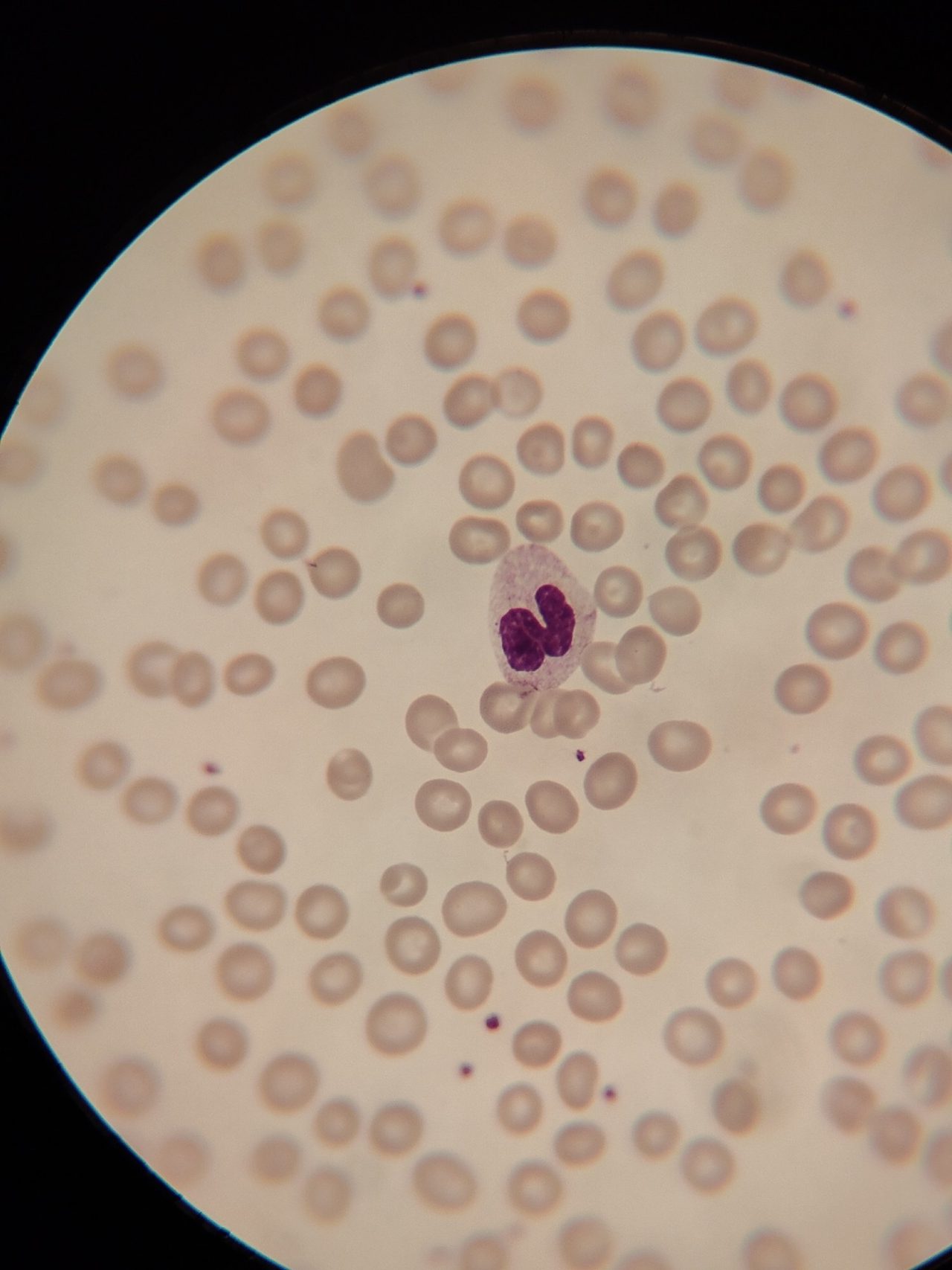 Neutrophil Hypogranulation: Causes and Morphology
