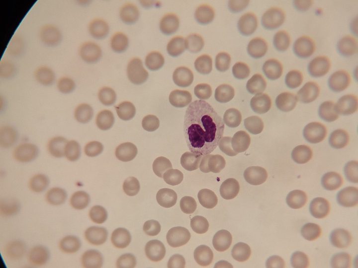 Blood smear: neutrophil with pronounced cytoplasmic hypogranulation