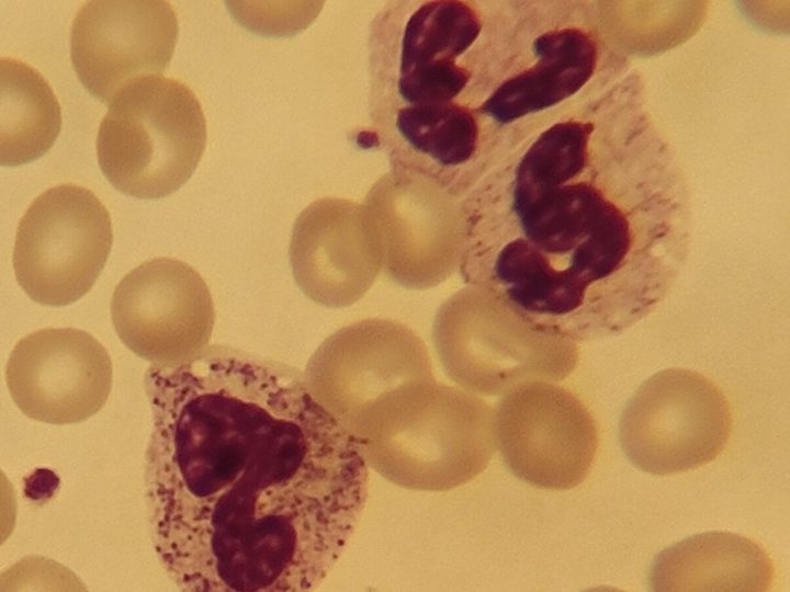 Blood smear: hypogranulated neutrophil (arrow) and a cell with toxic granulation