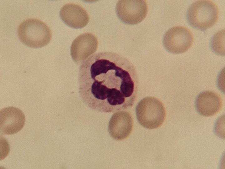 Blood smear: hypogranulated neutrophil with a ring-shaped nucleus