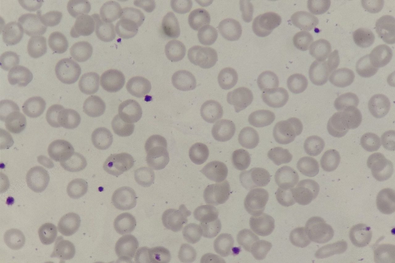 Hypochromia of Erythrocytes in Blood Smear: Causes and Morphology