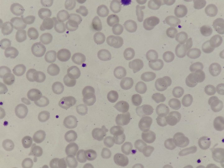 Blood smear: pronounced hypochromia and anisocytosis of erythrocytes