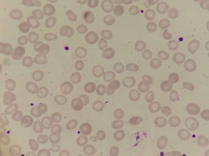 Blood smear: hypochromic erythrocytes with an enlarged central pallor