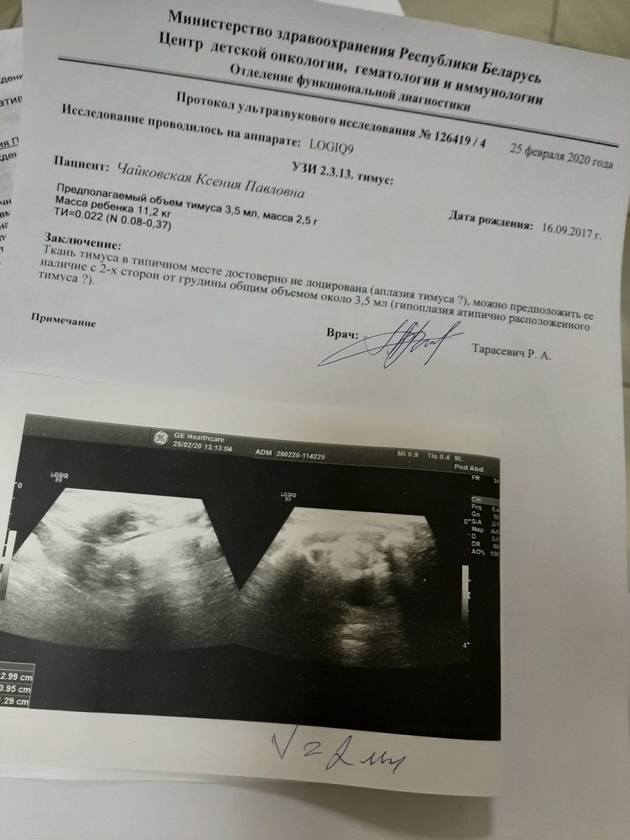Thymus Hypoplasia and Aplasia in Children: Ultrasound Data