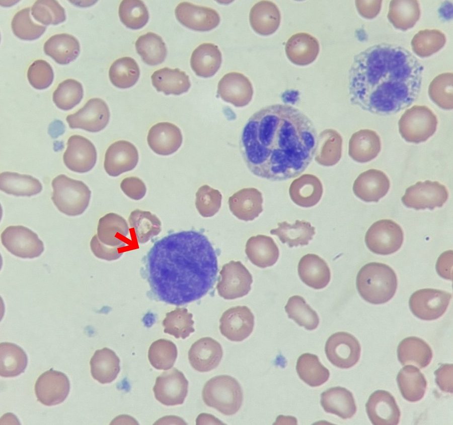 Naked Megakaryocyte Nuclei in Primary Myelofibrosis
