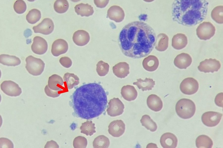 Naked Megakaryocyte Nuclei in Primary Myelofibrosis