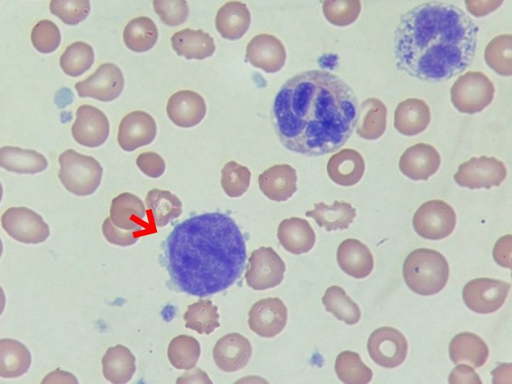Blood smear: naked megakaryocyte nucleus in primary myelofibrosis, x1000