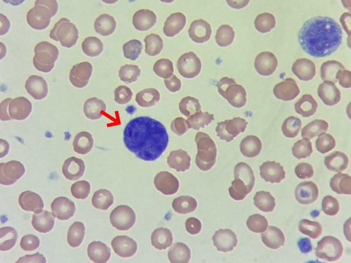 Blood smear: megakaryocyte nucleus without cytoplasm and erythrocyte poikilocytosis