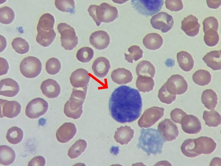 Blood smear: circulating megakaryocyte nucleus with anisocytosis, x1000