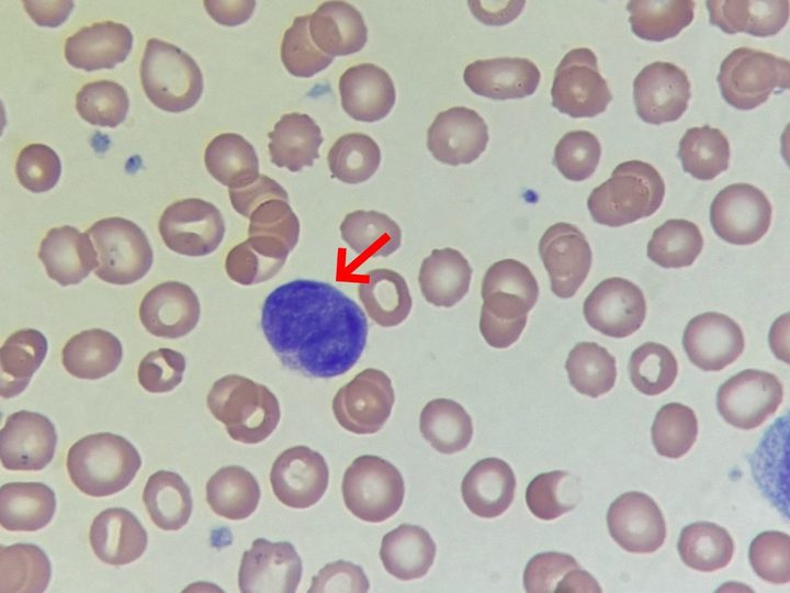 Blood smear: naked megakaryocyte nucleus with dense chromatin in a blood smear