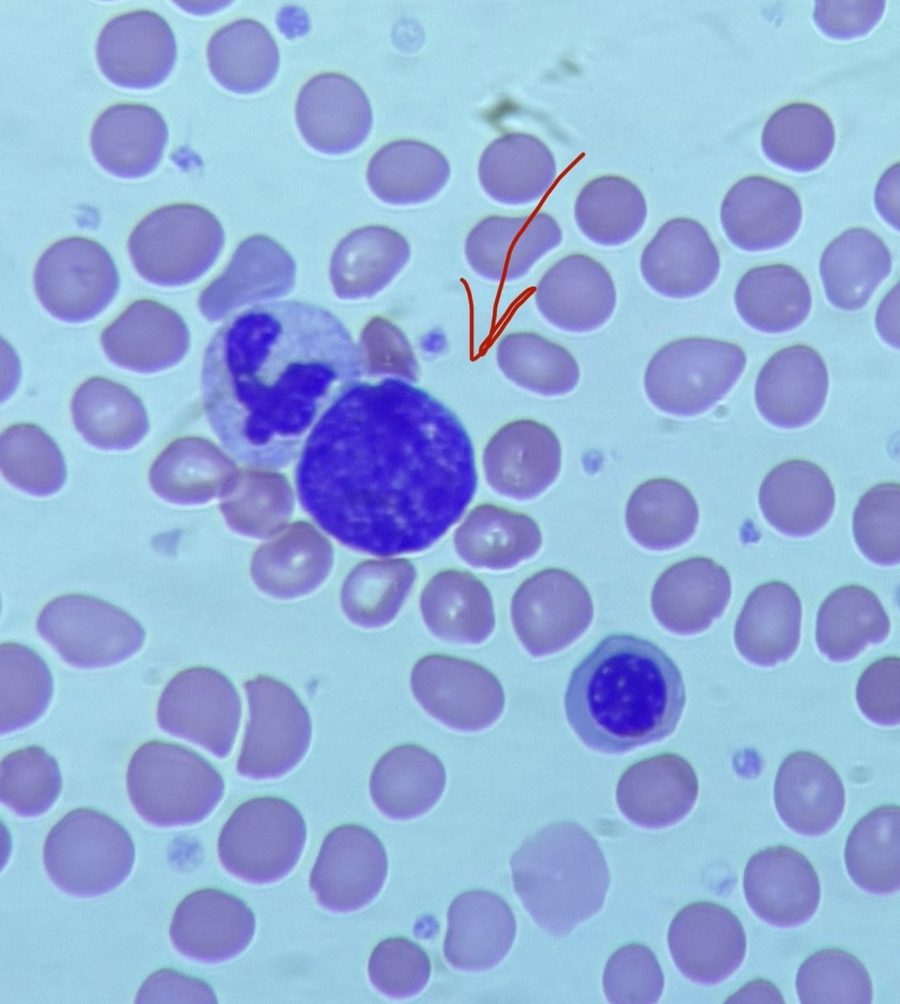 Naked Megakaryocyte Nuclei in Peripheral Blood Smear