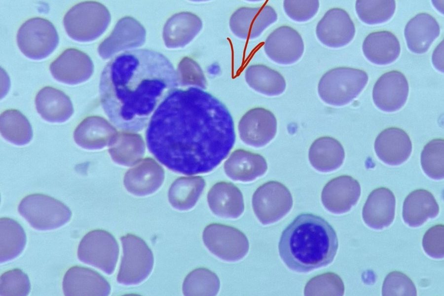 Naked Megakaryocyte Nuclei in Peripheral Blood Smear