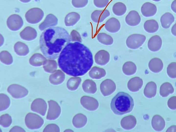 Blood smear: naked megakaryocyte nucleus (arrow), neutrophil, and normoblast