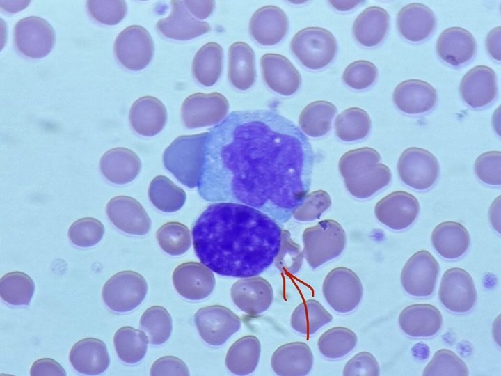 Blood smear: naked megakaryocyte nucleus indicated by an arrow, next to a neutrophil