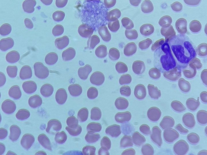 Blood smear: segmented neutrophil, normoblast, and megakaryocyte nucleus