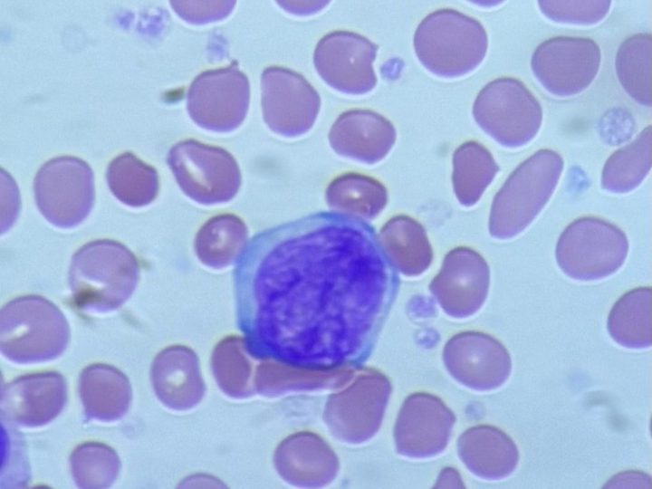 Blood smear: round naked megakaryocyte nucleus with dense chromatin