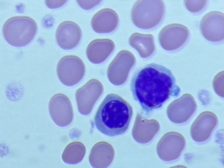 Blood smear: normoblast and naked megakaryocyte nucleus in the same field of view