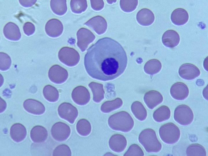 Blood smear: normoblast with dense, eccentrically located nucleus