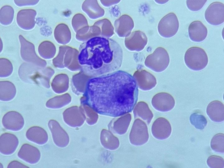 Blood smear: segmented neutrophil in contact with a megakaryocyte nucleus